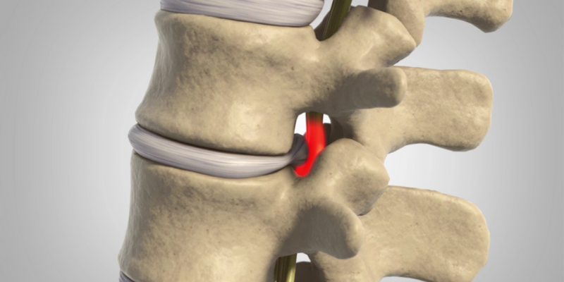 Spinal (Lumbar & Cervical) Stenosis  Scottsdale, AZ Orthopedic Spine  Surgery