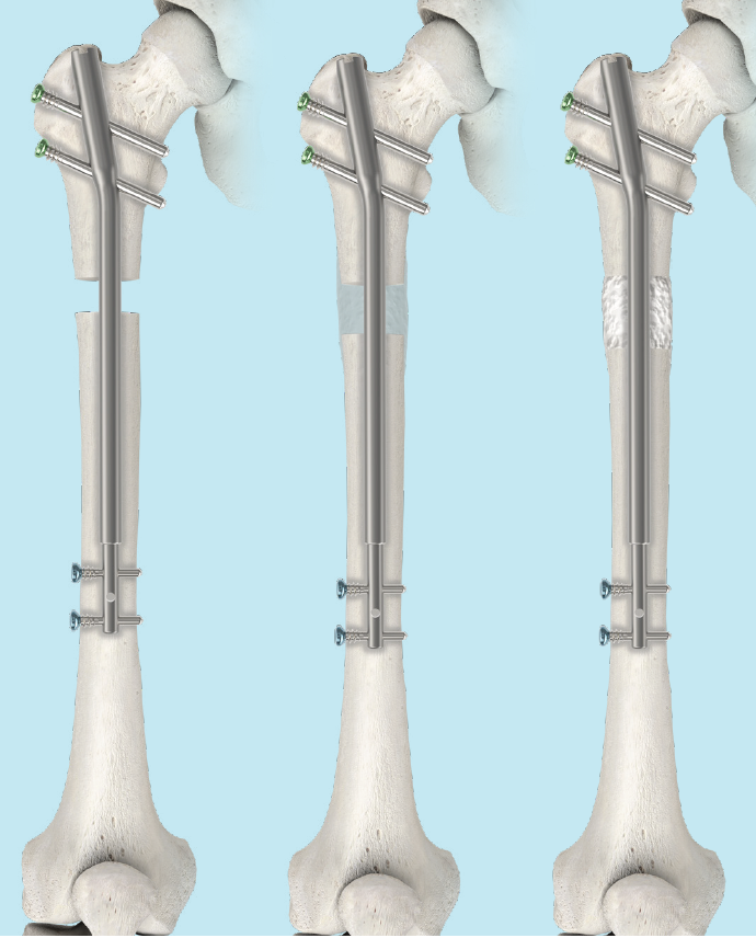 Bone Transport International Center for Limb Lengthening