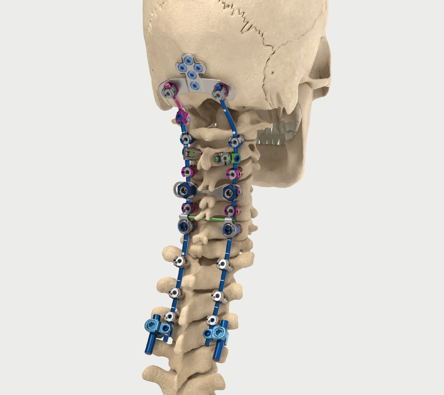 Posterior Fixation NuVasive